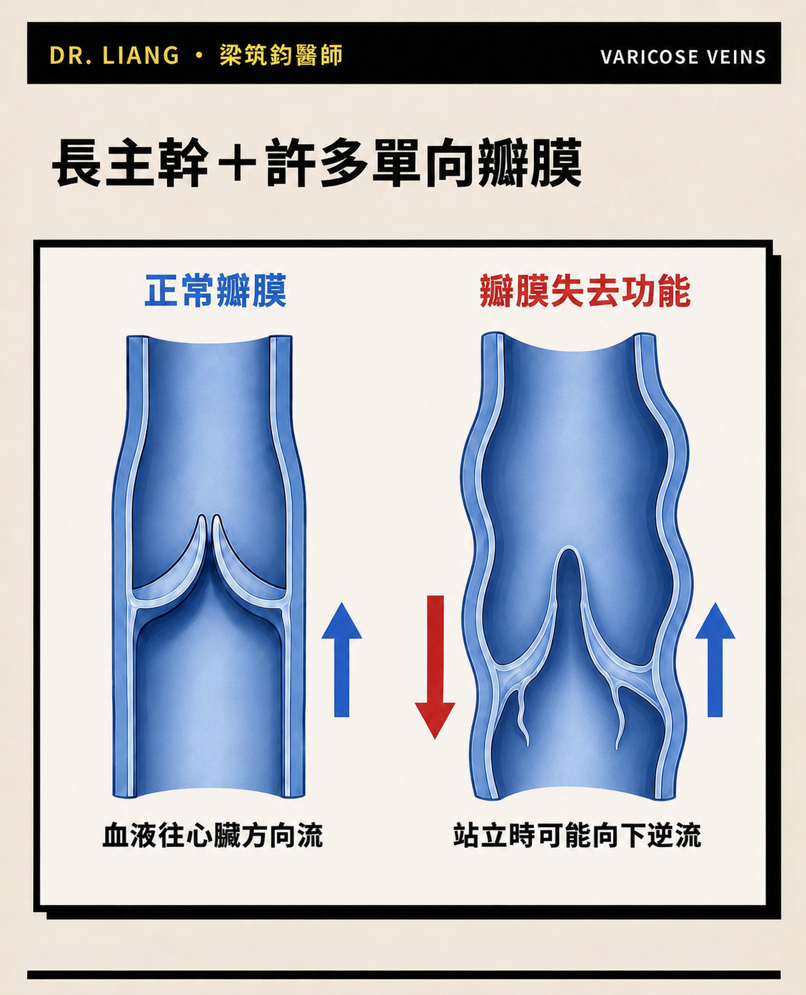 Comparison of a functioning venous valve and venous reflux
