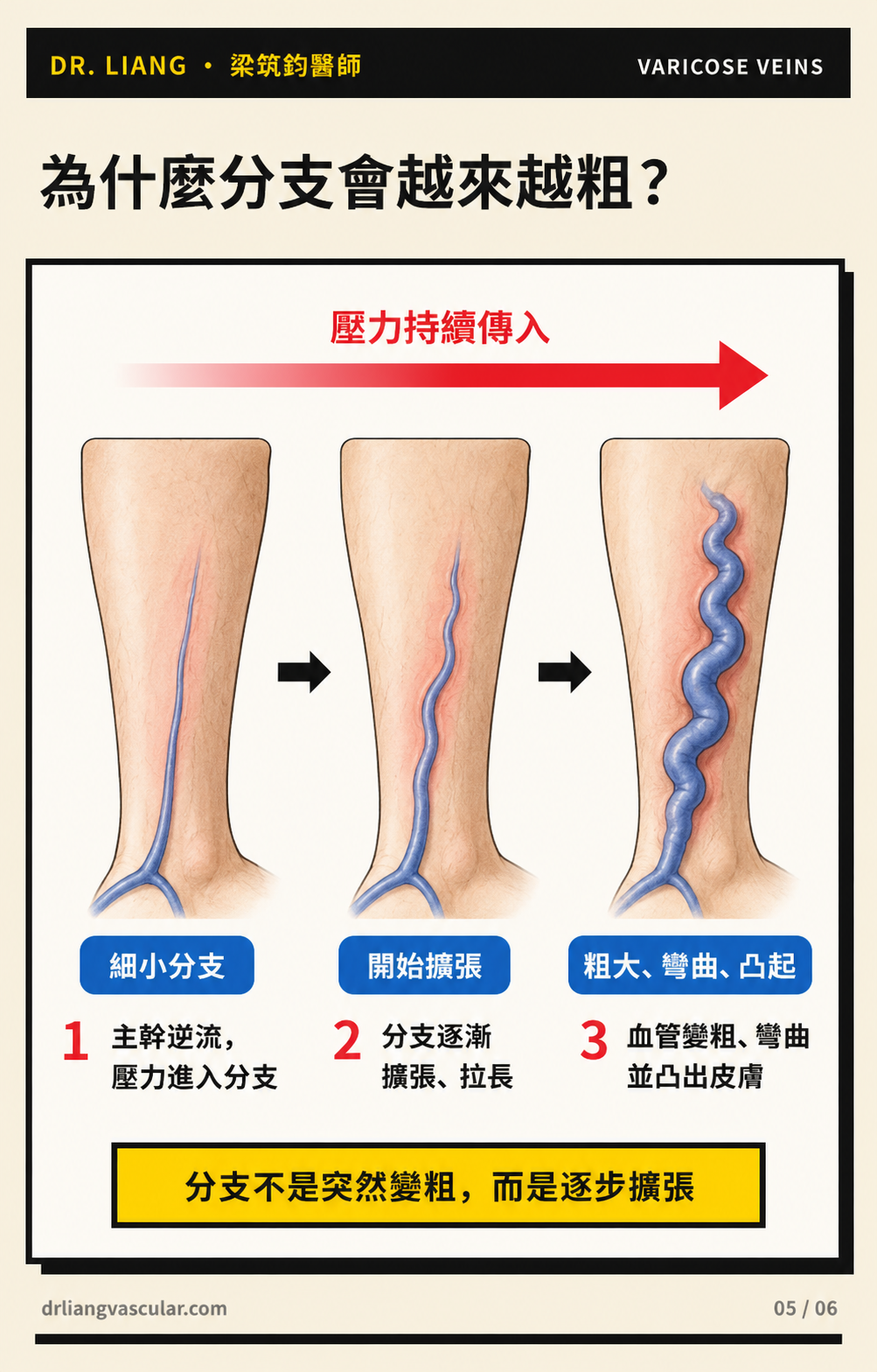 Progressive enlargement, tortuosity and bulging of tributary veins