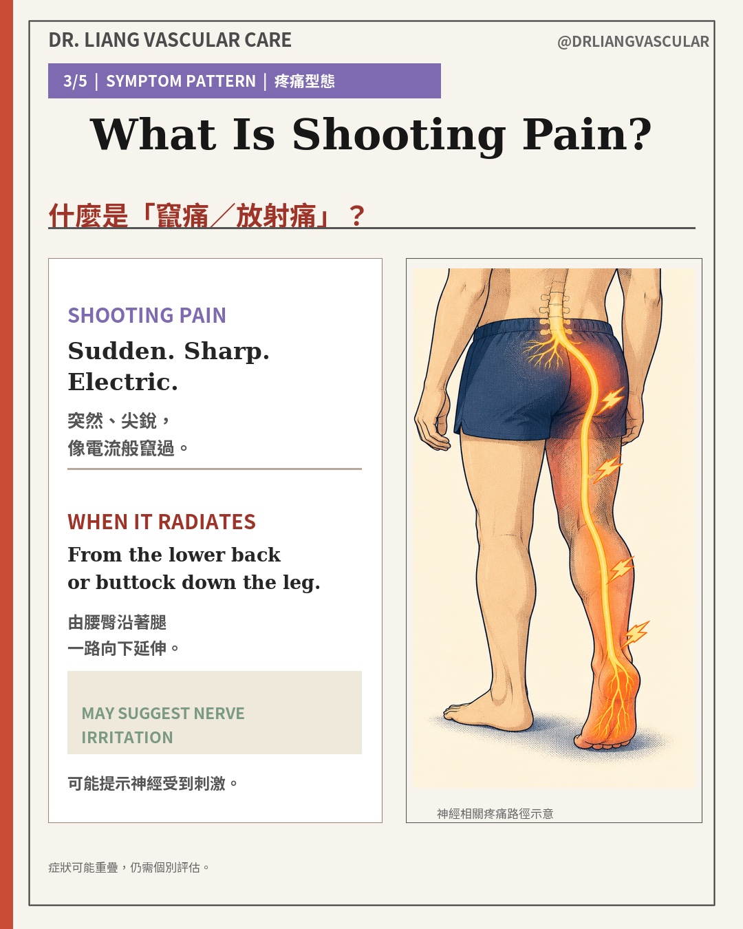 Illustration of shooting pain radiating from the lower back or buttock down the leg toward the foot